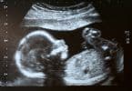 ultrasound picture - Gestational vs. Traditional surrogacy concept